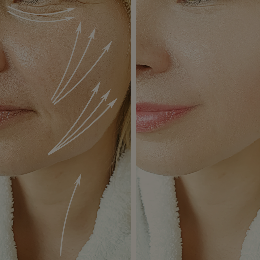 RF facelifting